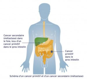 Comment se forme une tumeur ? - Fondation contre le cancer