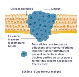 Tumeur malignes