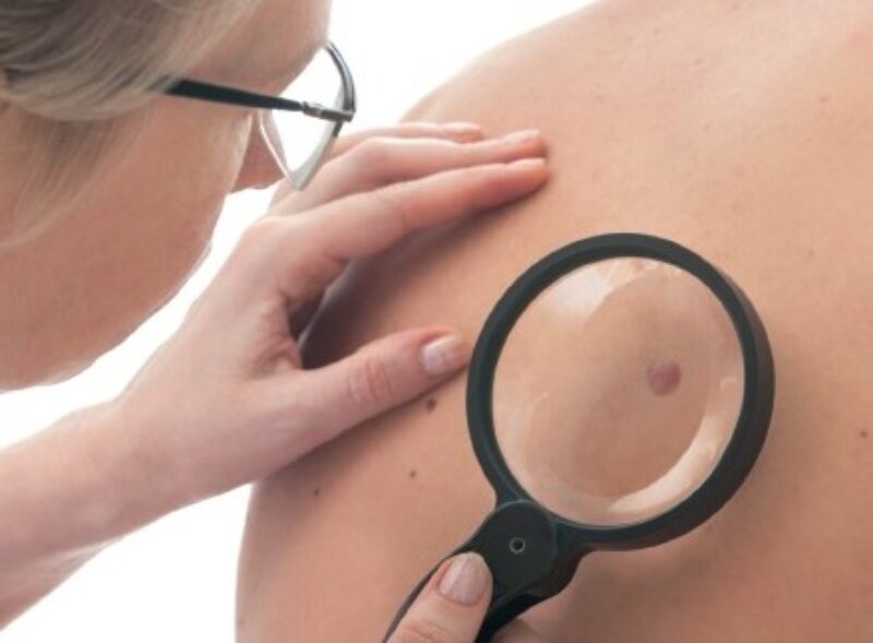Les cancers de la peau : mélanomes
