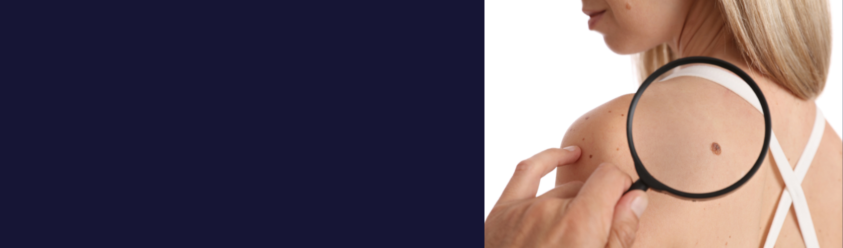 Les Belges sont de mauvais élèves en matière de protection UV